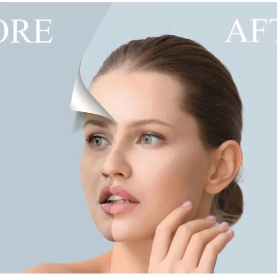 Microneedling viso